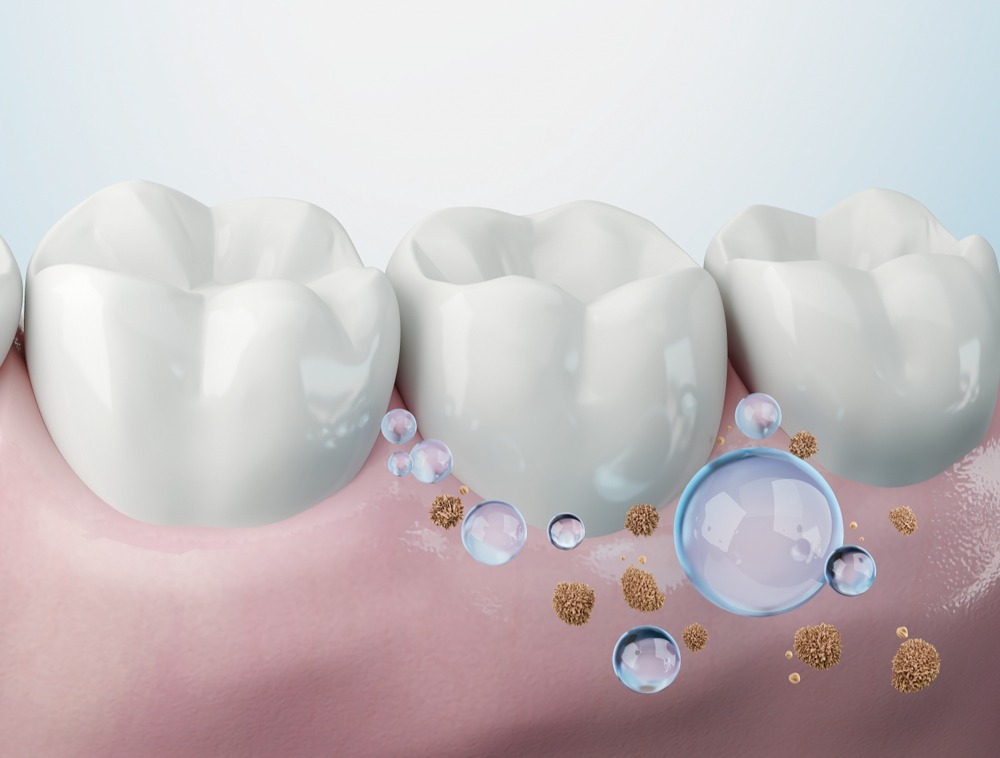 teeth cleaning

